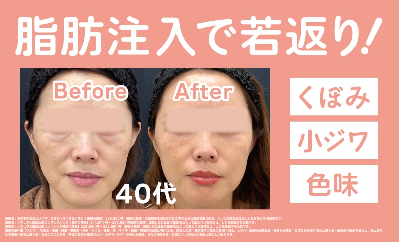 【福岡・天神・博多】脂肪注入で若返りができるからおすすめ｜しわ・たるみ改善＆自然なボリュームアップを叶える